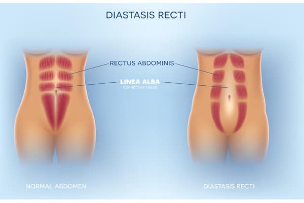 What Non-Surgical Options Are Available for Diastasis Recti Orrell?