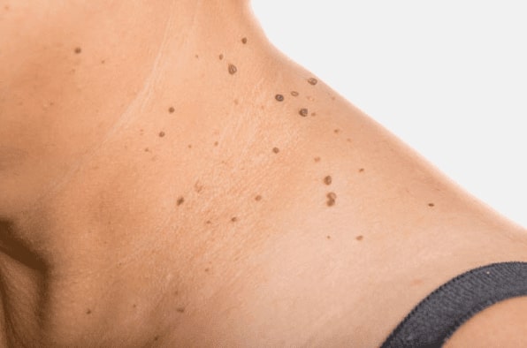 Are you looking for easy skin tag removal Orrell - then contact Spire today!