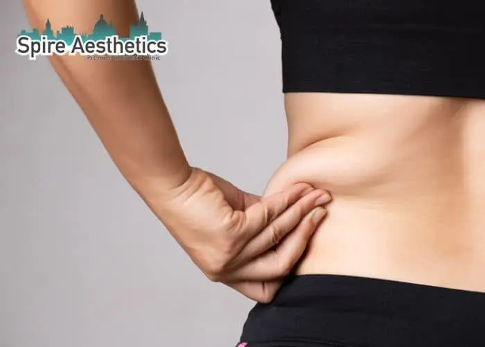 Image of woman pinching fat on their hips Orrell. Fat Freezing treatment