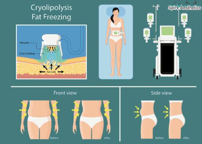 Image of diet and fat freezing combined for best results for Spire Aesthetics Orrell