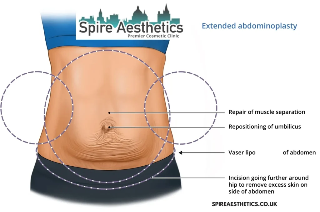 Understanding Loose Skin After Gastric Band Orrell Surgery and HIFU Treatment