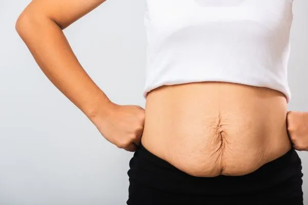 Image of a woman's stomach after weight loss with sagging skin following a gastric band Orrell