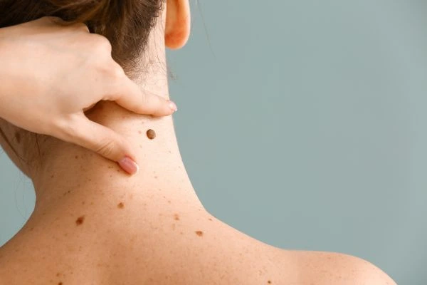 skin blemish removal Orrell treatment