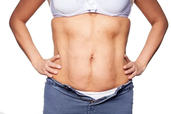 sagging skin on woman's stomach after weight loss injections Orrell