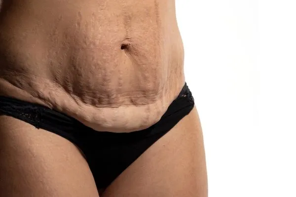 Image of womans stomach after weight loss injections Orrell showing saggy skin